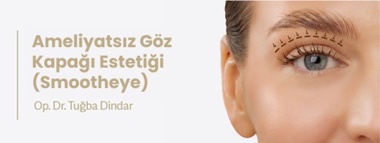 Ameliyatsız Göz Kapağı Estetiği (Smootheye)